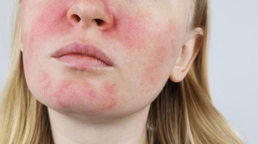 How Is Rosacea Treated - 4 Things That Actually Helped Rosacea