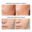 photo skin rejuvenation