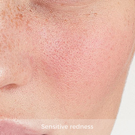 sensitive skin showing redness and irritation