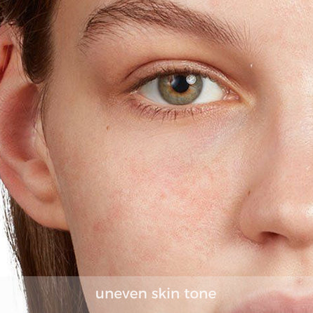 uneven skin tone and pigmentation spots